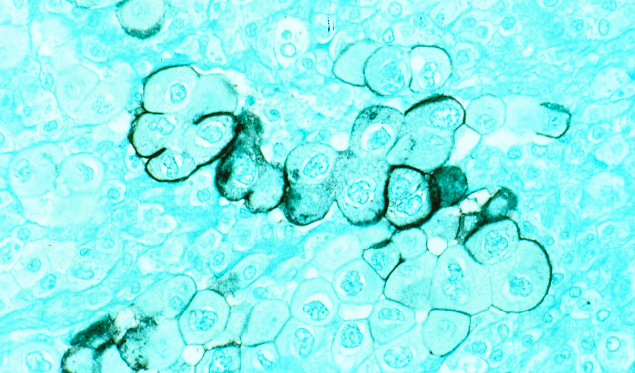 Blocking IL1RAP May Strip Pancreatic Cancer of Its Defenses
